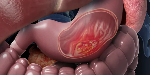 Cancerul gastric reprezintă a cincea formă de tumoare la nivel mondial Foto Willis Knighton Health 